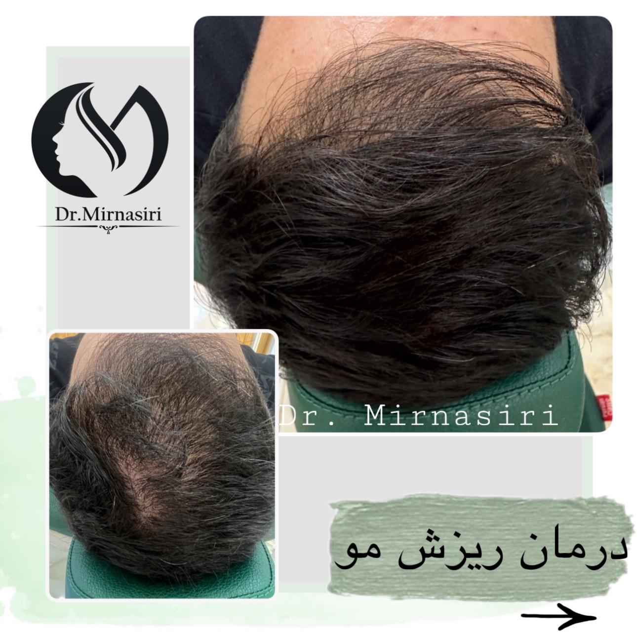 درمان ریزش مو