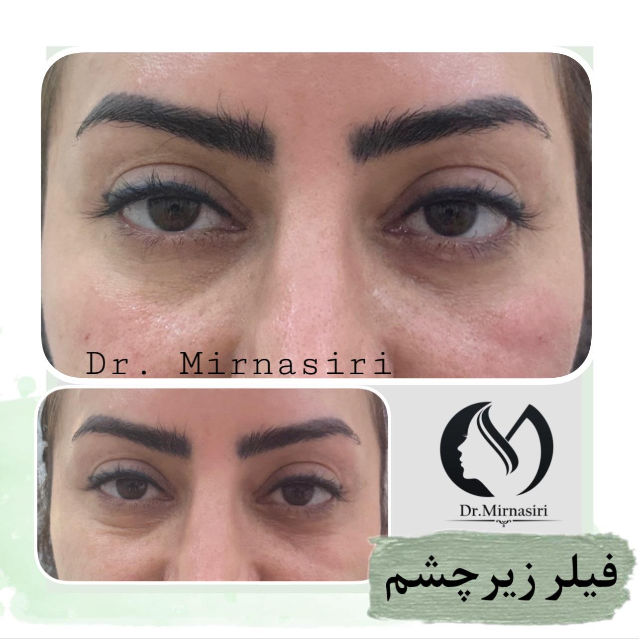 فیلر زیر چشم