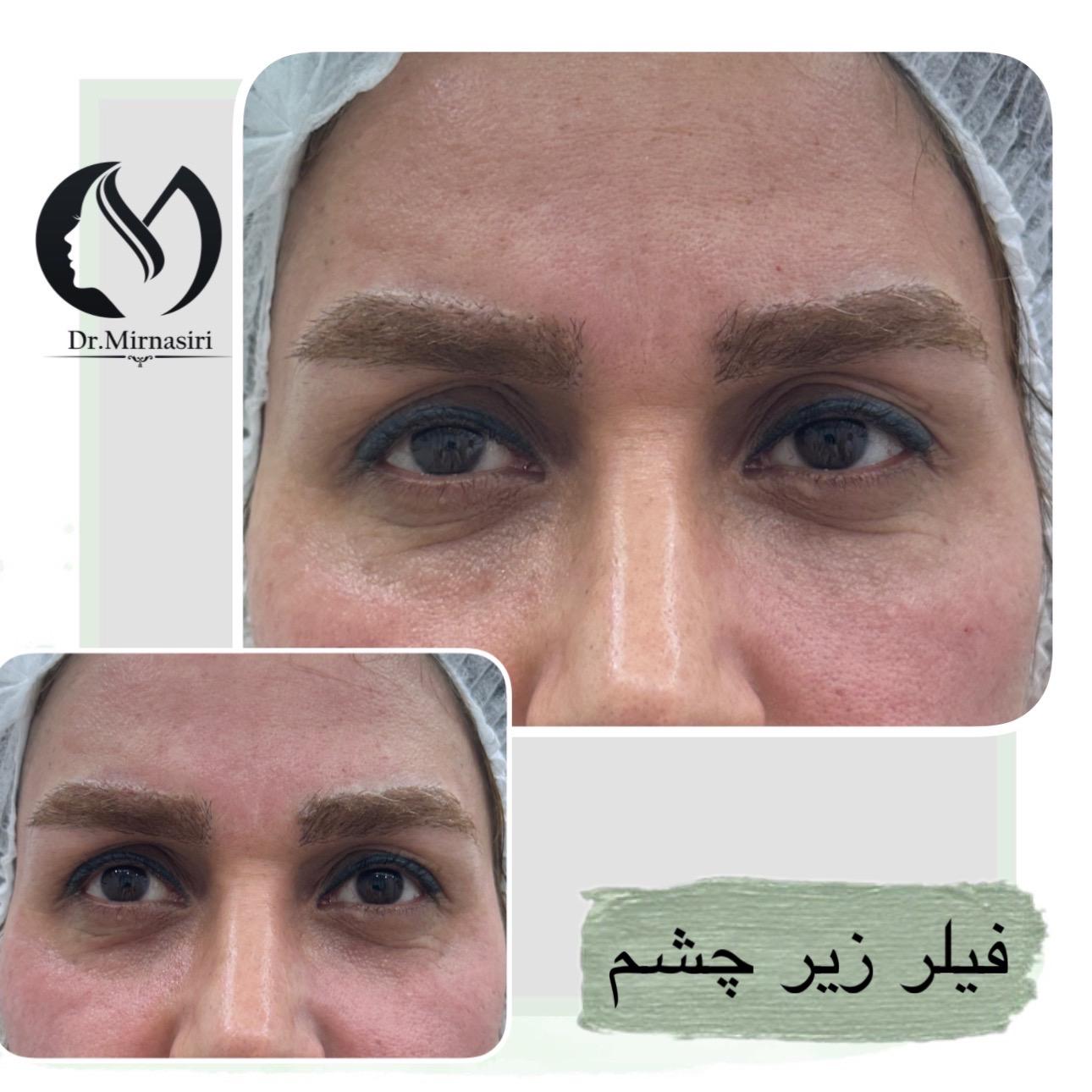 فیلر زیر چشم