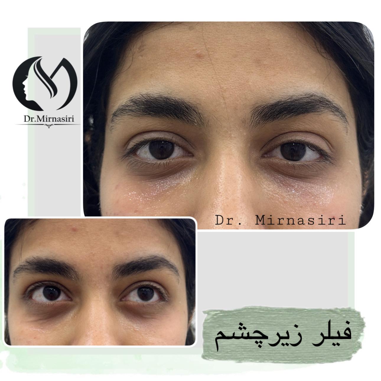 فیلر زیر چشم